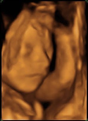 4D ultrasound