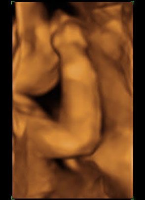 4D ultrasound