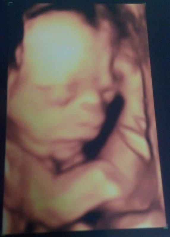 4D ultrasound